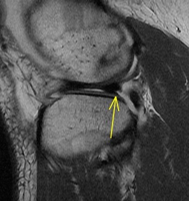 Figure 3 for case Unstable lateral meniscus flap tear